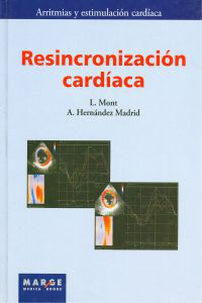Resincronizacion cardiaca